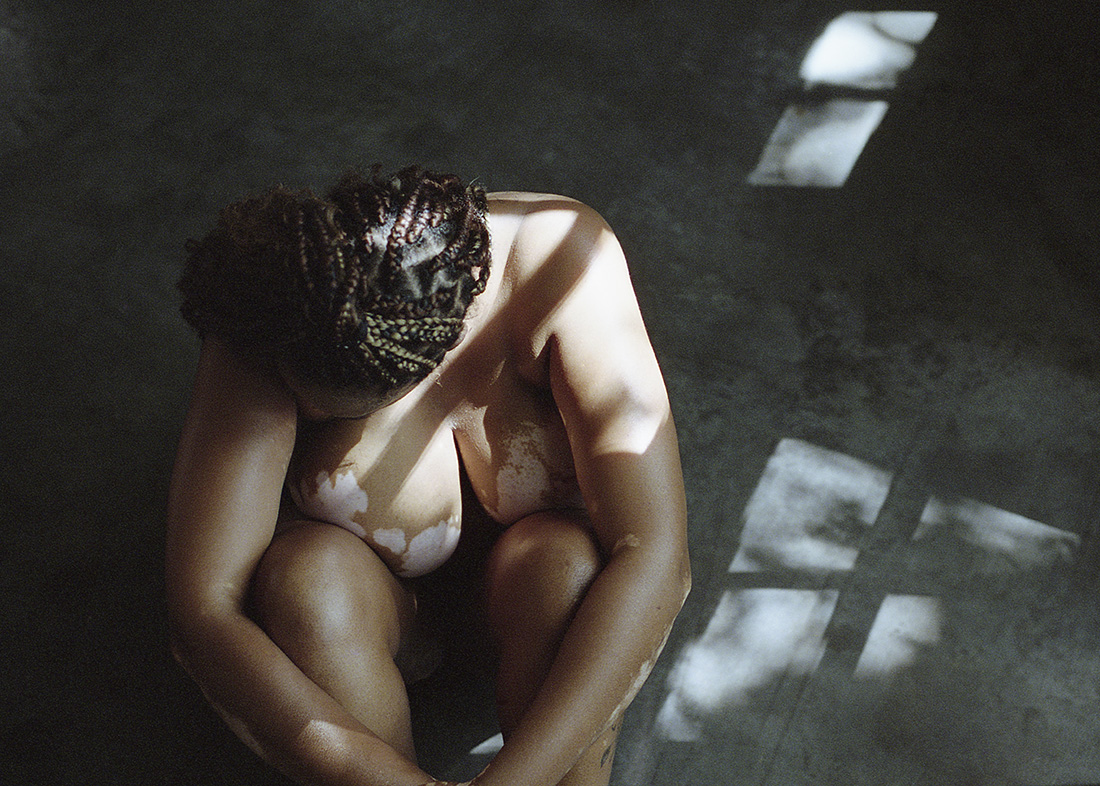 Vitiligo beauty photographer